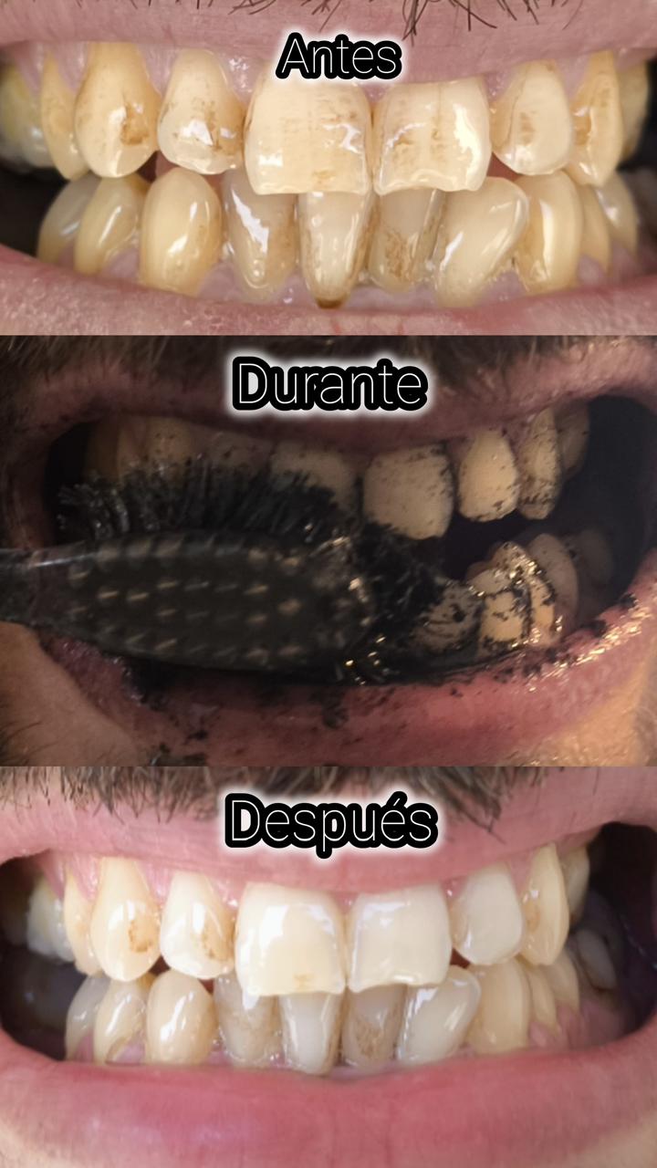 Blanqueador Dental